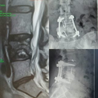 Spinal Story